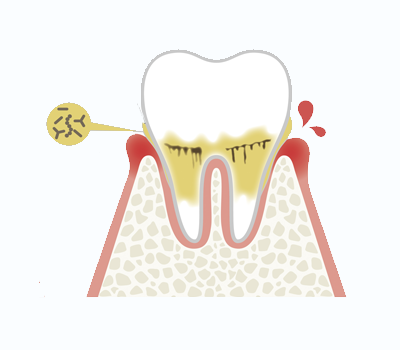 歯肉炎