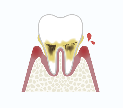 歯周炎（軽度）