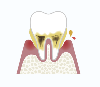 歯周炎（中度）