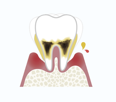 歯周炎（重度）